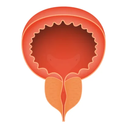 前立腺がん