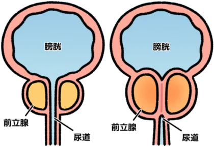 前立腺肥大症