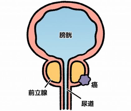 前立腺がん